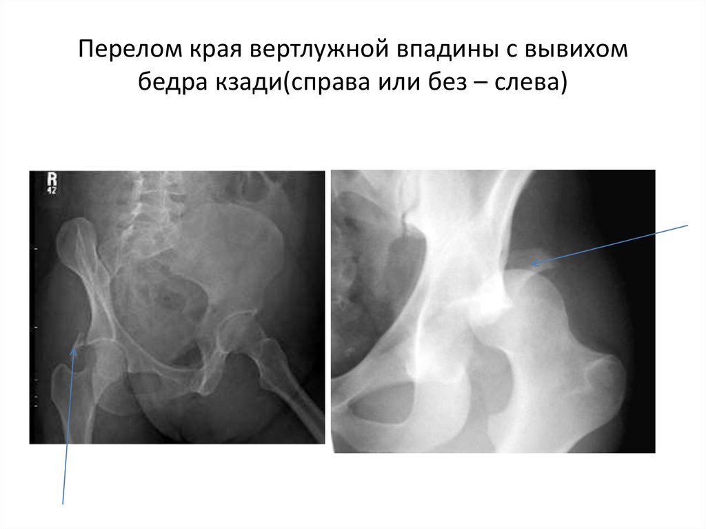 Перелом кости вертлужной впадины