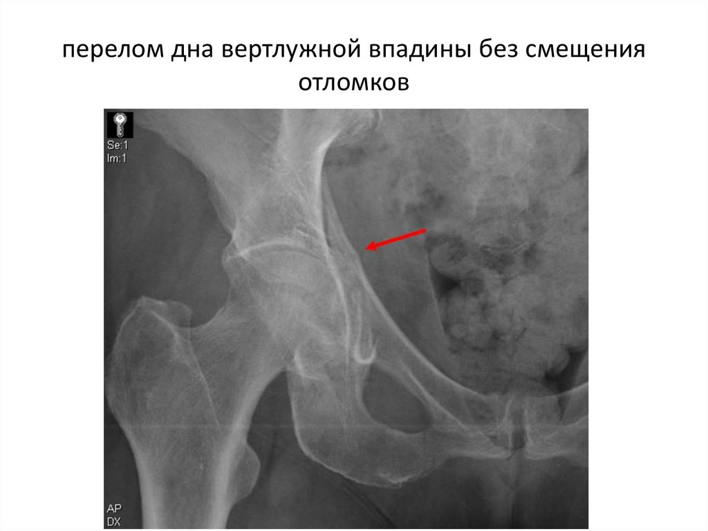 Перелом вертлужной впадины презентация