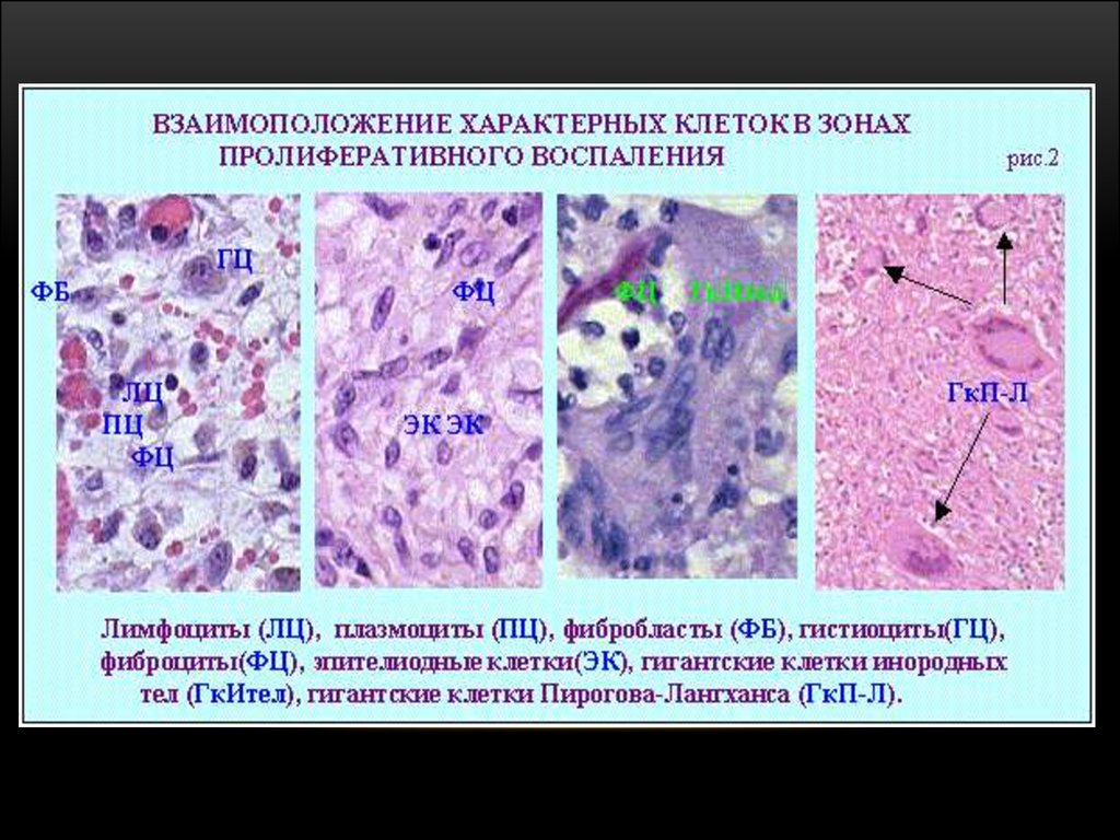 Пролиферативный. Пролиферация воспаление патанатомия. Клетки воспаления патанатомия. Альтерация экссудация пролиферация патанатомия. Пролиферация фибробластов гистология.
