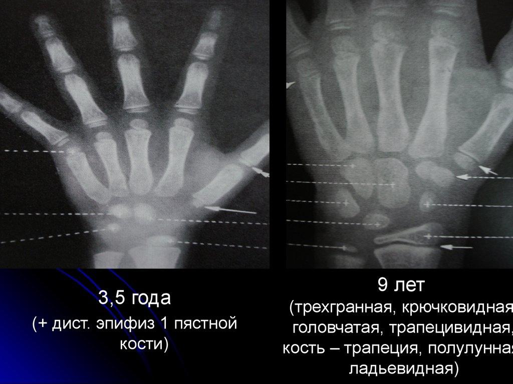 Первой пястной кости. Зоны роста пястных костей. Дистальный эпифиз пястной кости. Зоны роста кисти.