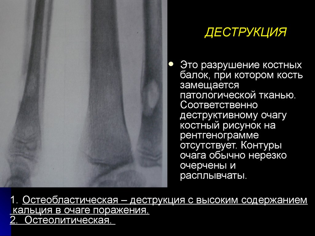 Для рентгенологической картины фолликулярной кисты характерна деструкция костной ткани в виде