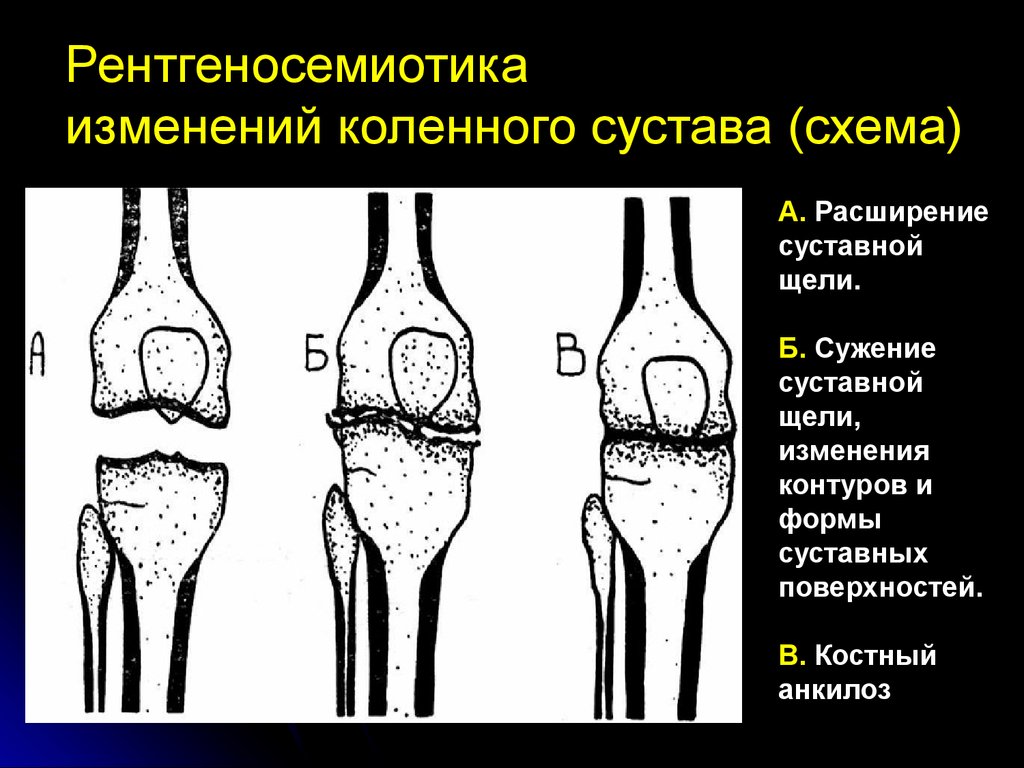 Изменение формы сустава. Расширение суставной щели рентген. Рентгенограмма коленного сустава ширина суставной щели. Изменение рентгеновской суставной щели. Суставная щель коленного сустава расширена.