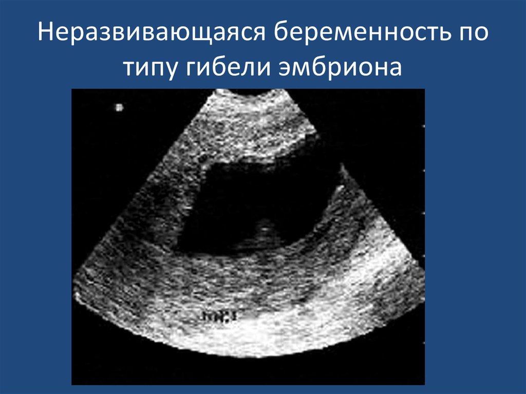 Причины неразвивающейся беременности. Неразвивающаяся беременность УЗИ. Неразвивающаяся (замершая) беременность. Не развивающая беременность. Неразвивающаяся беременность по типу гибели эмбриона.
