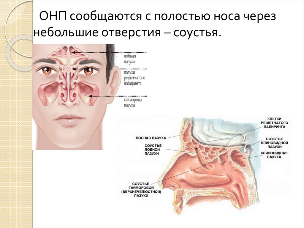 Соустье гайморовой пазухи. Соустье гайморовой пазухи носа. Соустье носовой полости. Соустье верхнечелюстной пазухи в полости носа.