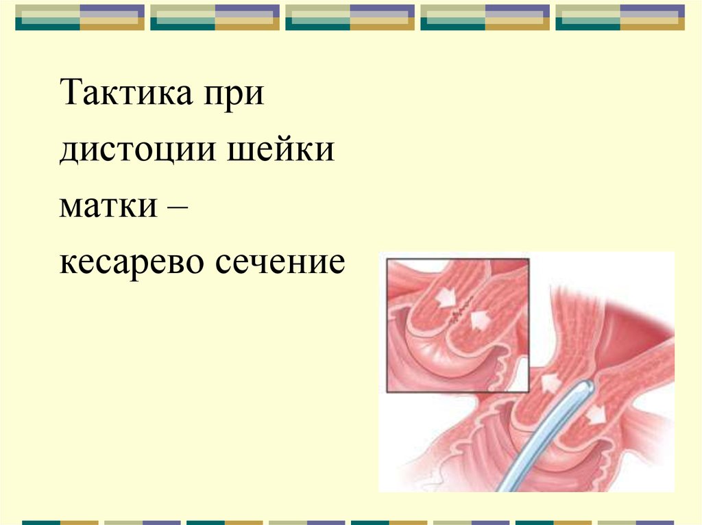 Дистоция шейки матки это. Циркуляторная дистоция шейки матки.