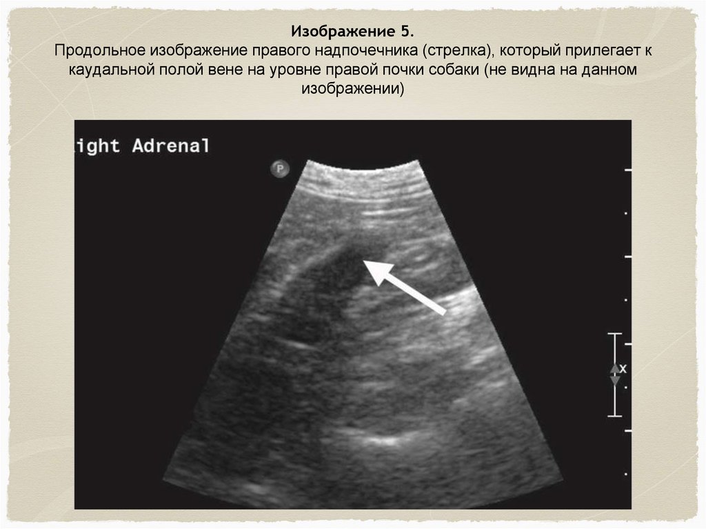 Надпочечники на узи фото