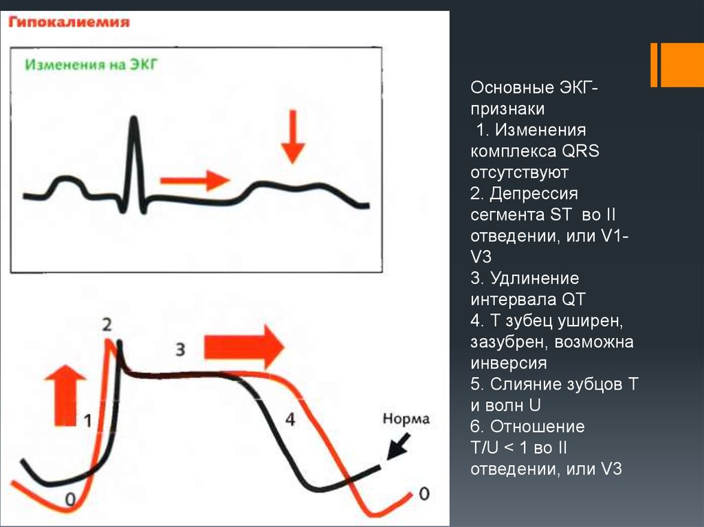 Изменения t. Сегмент St на ЭКГ депрессия в v1v2v3. ЭКГ 2 отведение зубец QRS зазубрен. Расширение QRS на ЭКГ. Изменения комплекса QRS на ЭКГ.