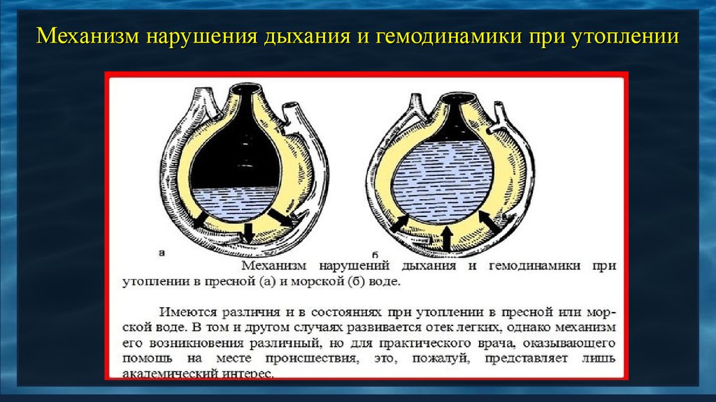 Клиническая картина утопление