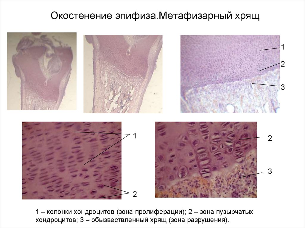 Аппозиционный рост хряща. Зона пузырчатого хряща гистология. Эпифизарная пластинка гистология. Метаэпифизарная пластинка гистология препарат. Зона пролиферации хряща.