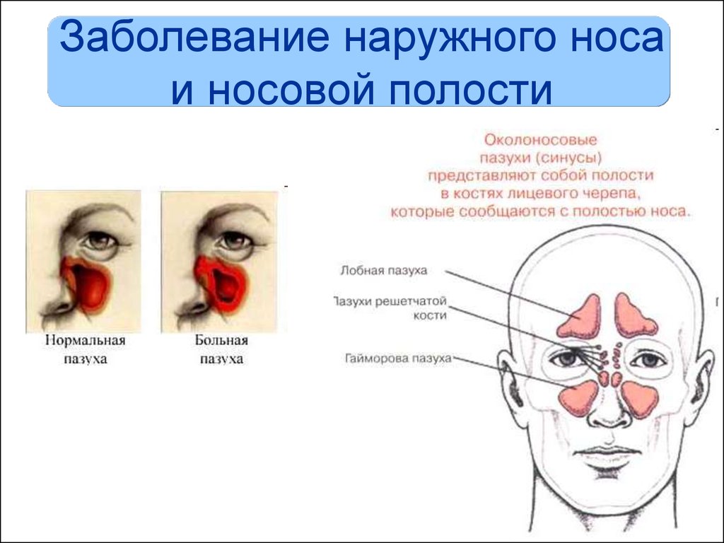 Заболевания придаточных пазух носа. Красные носовые пазухи снаружи. Заболевания носа и придаточных пазух. Поражения придаточных пазух носа.