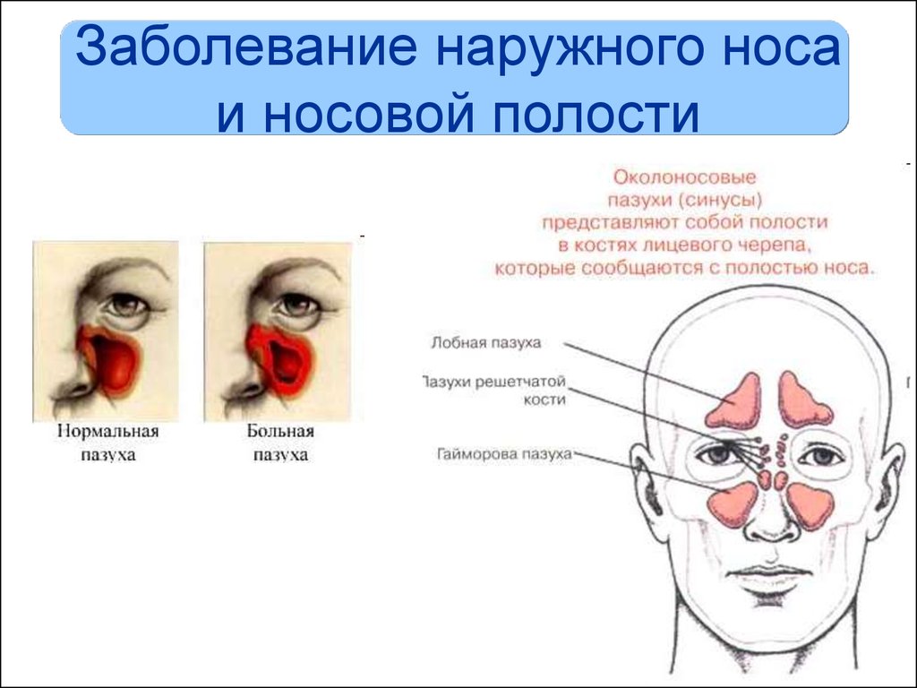 Болезни носа и придаточных. Красные носовые пазухи снаружи. Заболевания носа и придаточных пазух. Поражения придаточных пазух носа.