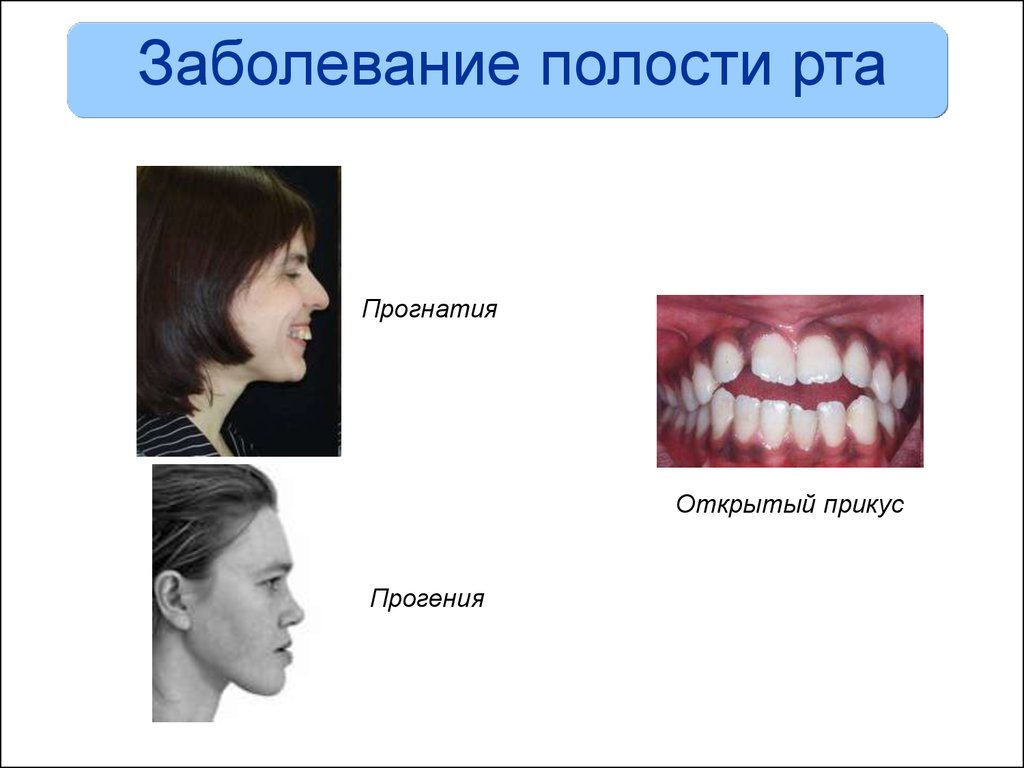 Инфекции полостей. Заболевания полости рта. Нарушения ротовой полости. Заболевания ротовой полости рта. Заболевания ротовой полости у человека.