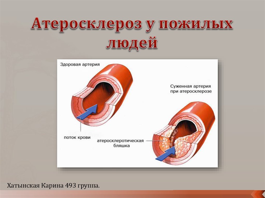 Презентация на тему атеросклероз