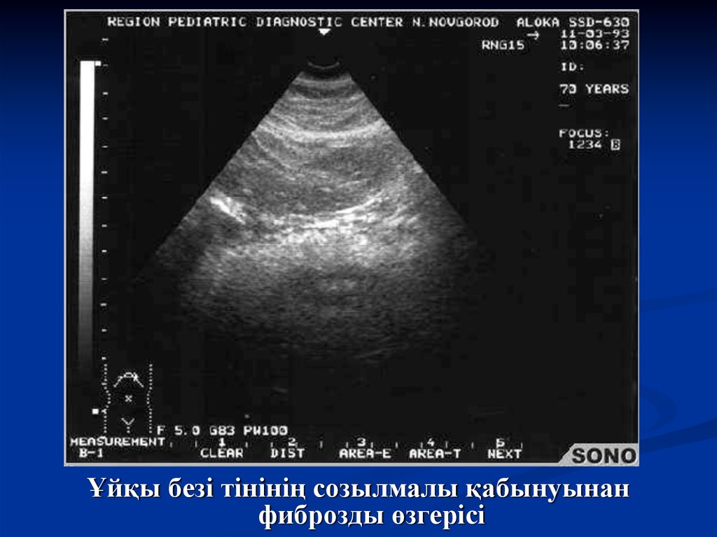 Неровные четкие контуры поджелудочной. УЗИ поджелудочной железы диффузно неоднородная. Диффузные изменения поджелудочной железы на УЗИ. Стеатоз поджелудочной железы на УЗИ. Изменение поджелудочной железы на УЗИ.