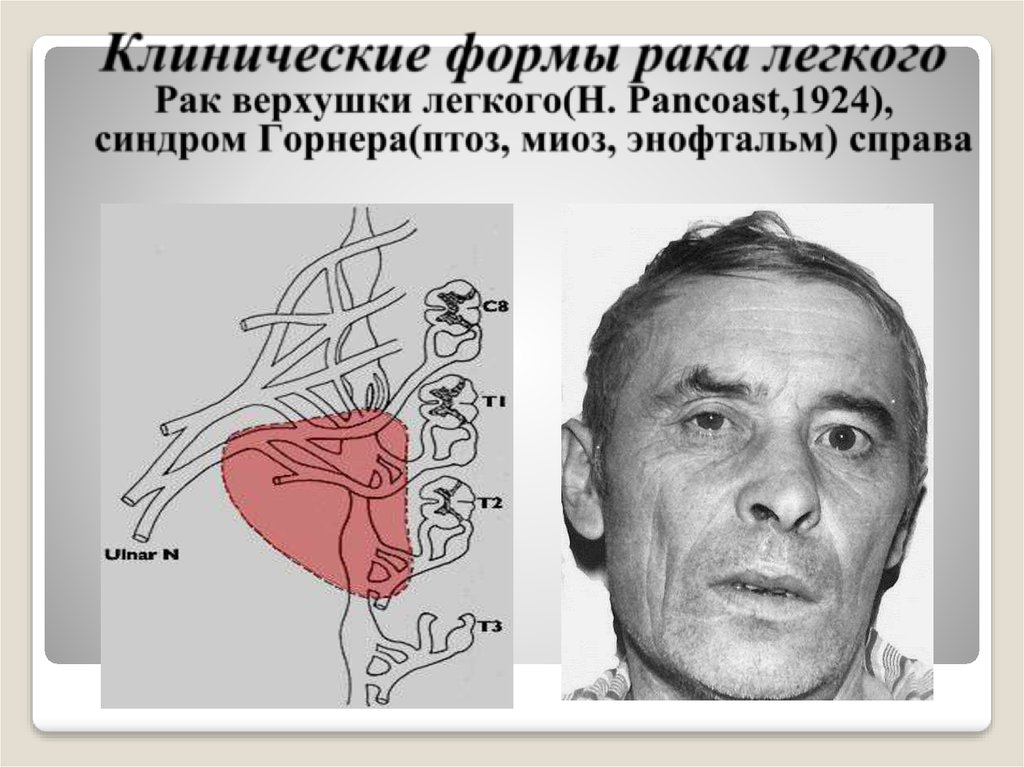 Клинические формы рака