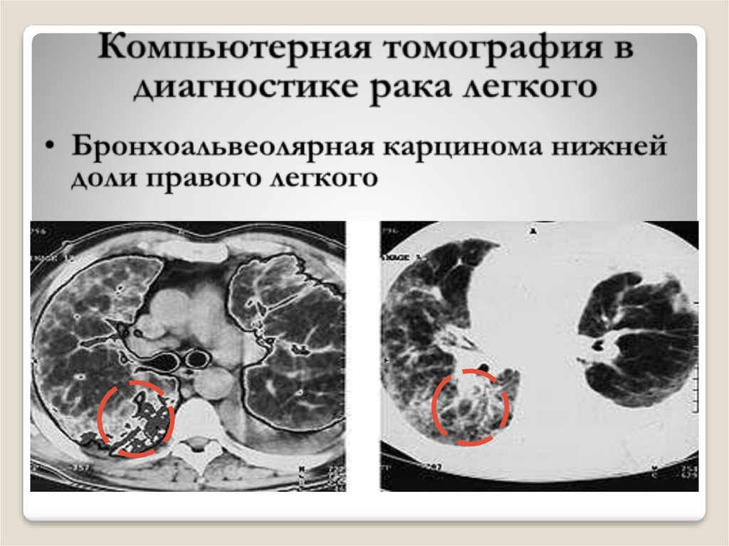 Кт при онкологии. Кт диагностика опухолей легких. Гемосидероз нижней доли легкого компьютерная томография.