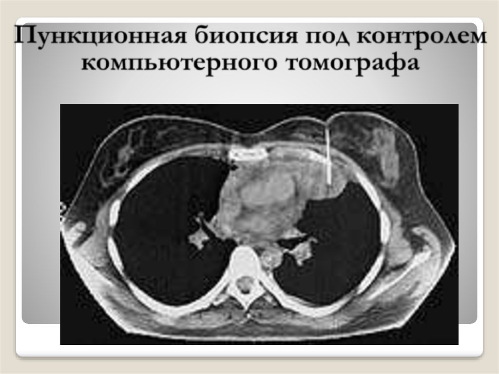 Биопсия легких. Тонкоигольная биопсия легкого под контролем кт. Переферическое образование верхней доли левого лёгкого. Трансторакальная биопсия под контролем кт. Трансторакальная тонкоигольная биопсия.