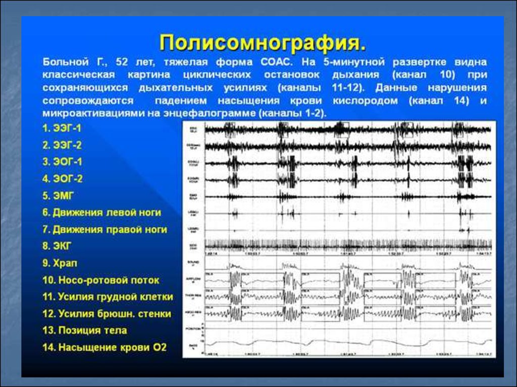 Полисомнография. Полисомнографическое исследование. Полисомнографическое исследование сна. Полисомнография показатели.