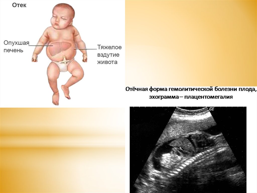Увеличена печень у новорожденного. Отечная форма гемолитической болезни плода. Гемолитическая болезнь новорожденного отечная форма. Отёчная форма ГБН У новорожденных. Отечная форма при гемолитической болезни новорожденных.
