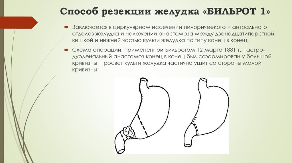 Бильрот 1 и 2 схема кратко