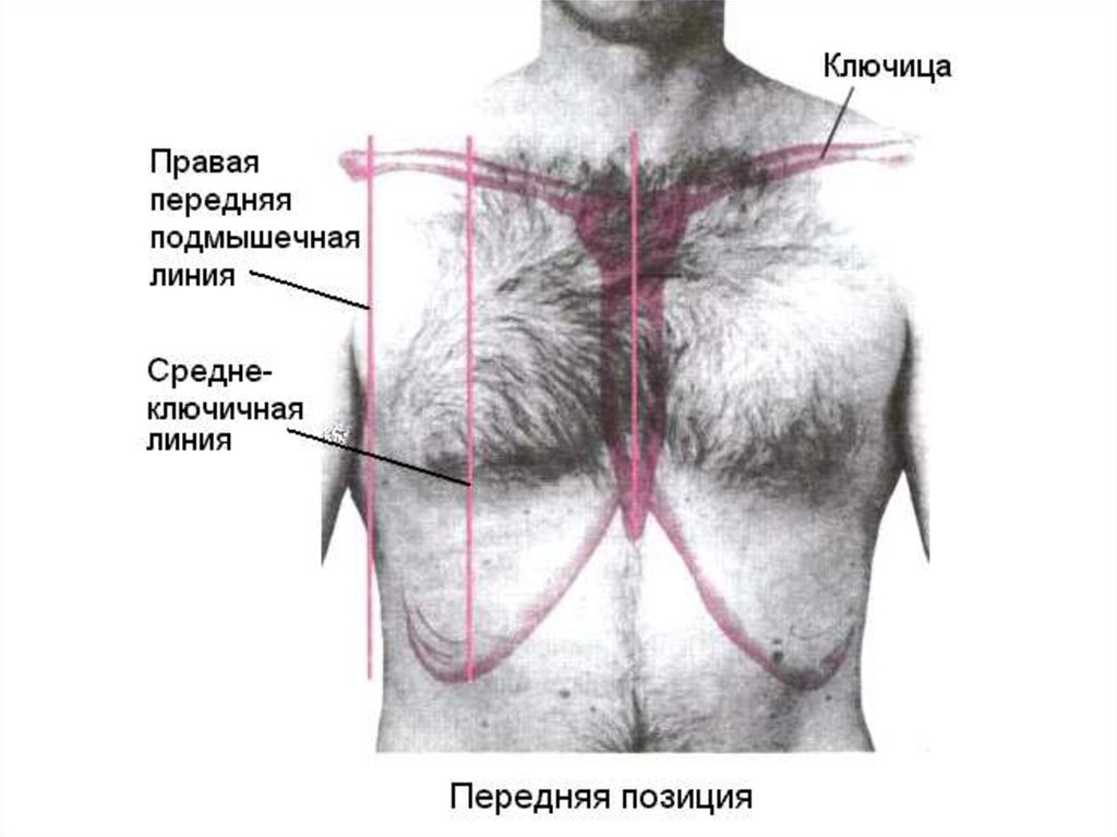 Линии ребер. Передняя аксиллярная линия грудной клетки. Угол Людовика пропедевтика. Линии передней поверхности грудной клетки анатомия. Топографические ориентиры грудной клетки.