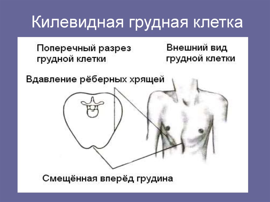 Изменение грудной. Патологические формы грудной клетки килевидная. Килевидная грудная клетка. Клеевидная грудная клетка. Килевидная деформация грудной клетки.