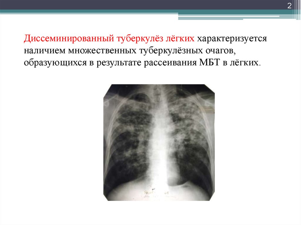 Острый диссеминированный туберкулез. Хронический диссеминированный туберкулез рентген. Хронический диссеминированный туберкулез легких рентген. Диссеминированный туберкулез легких снимки рентген. Диссеминированный туберкулез легких рентгенограмма.