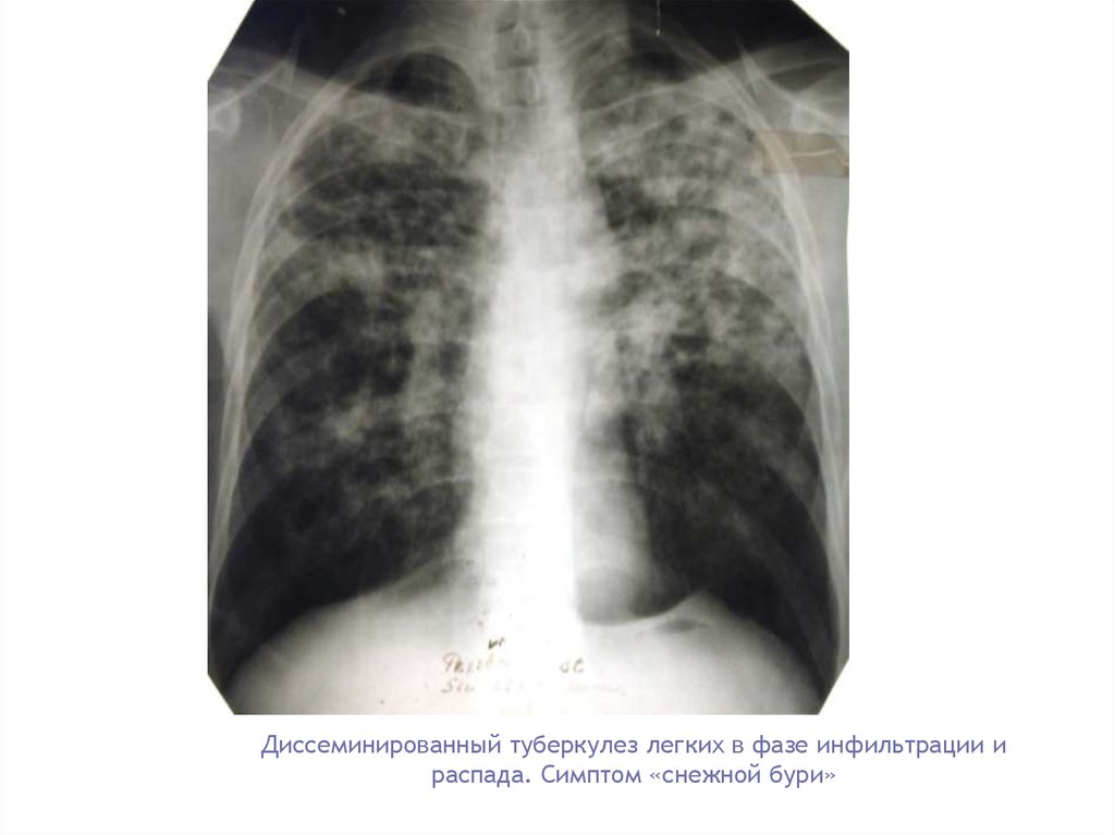 Туберкулез легкого рентгенограмма. Подострый диссеминированный туберкулез рентген. Острый диссеминированный туберкулез рентген. Подострый диссиминированный туберкулёз рентген. Лимфогенный диссеминированный туберкулез.