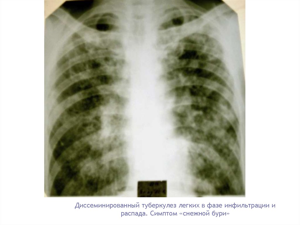 Инфильтративного в фазе распада. Острый диссеминированный туберкулез рентген. Диссеминированный инфильтративный туберкулез. Очаговый и диссеминированный туберкулез. Диссеминированный туберкулез на кт.