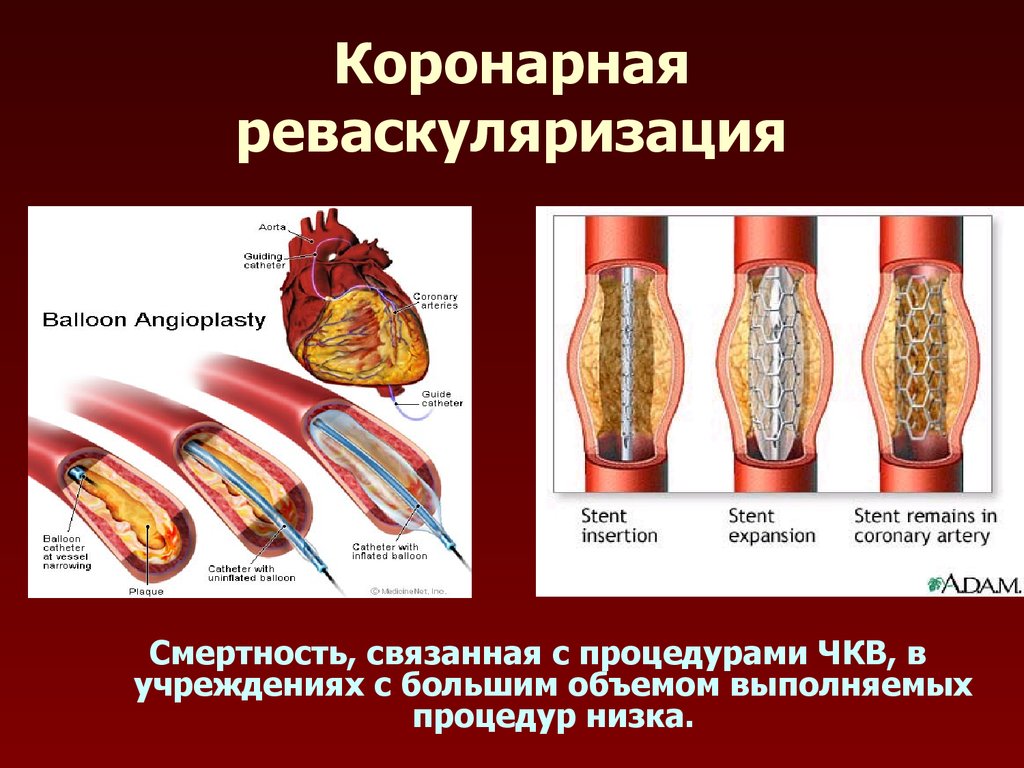 Коронарное стентирование. Реваскуляризация ЧКВ. Эндоваскулярная реваскуляризация миокарда. Хирургическая реваскуляризация миокарда. Коронарная реваскуляризация миокарда.