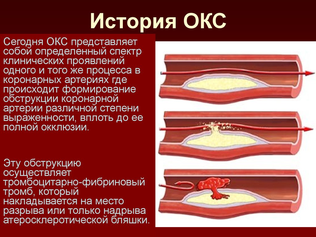 Клиническая картина окс