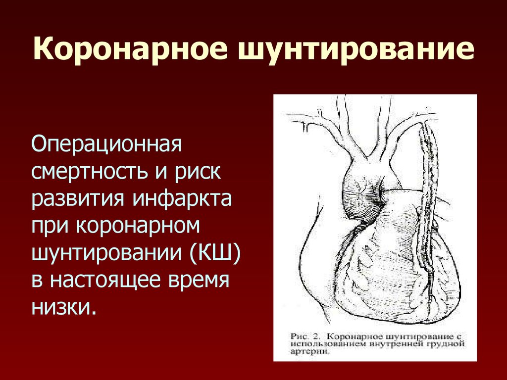 Схема аортокоронарного шунтирования