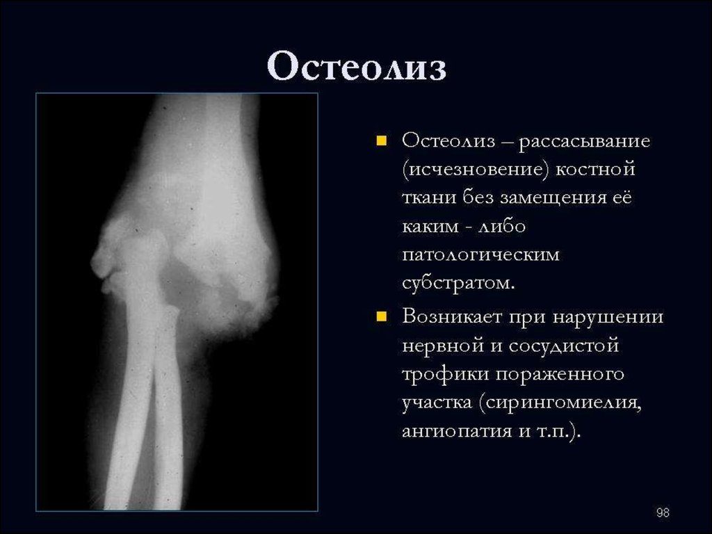 Остеолиз это. Рентгенологические признаки остеолиза. Остеолиз костной ткани. Остеолиз бедренной кости.