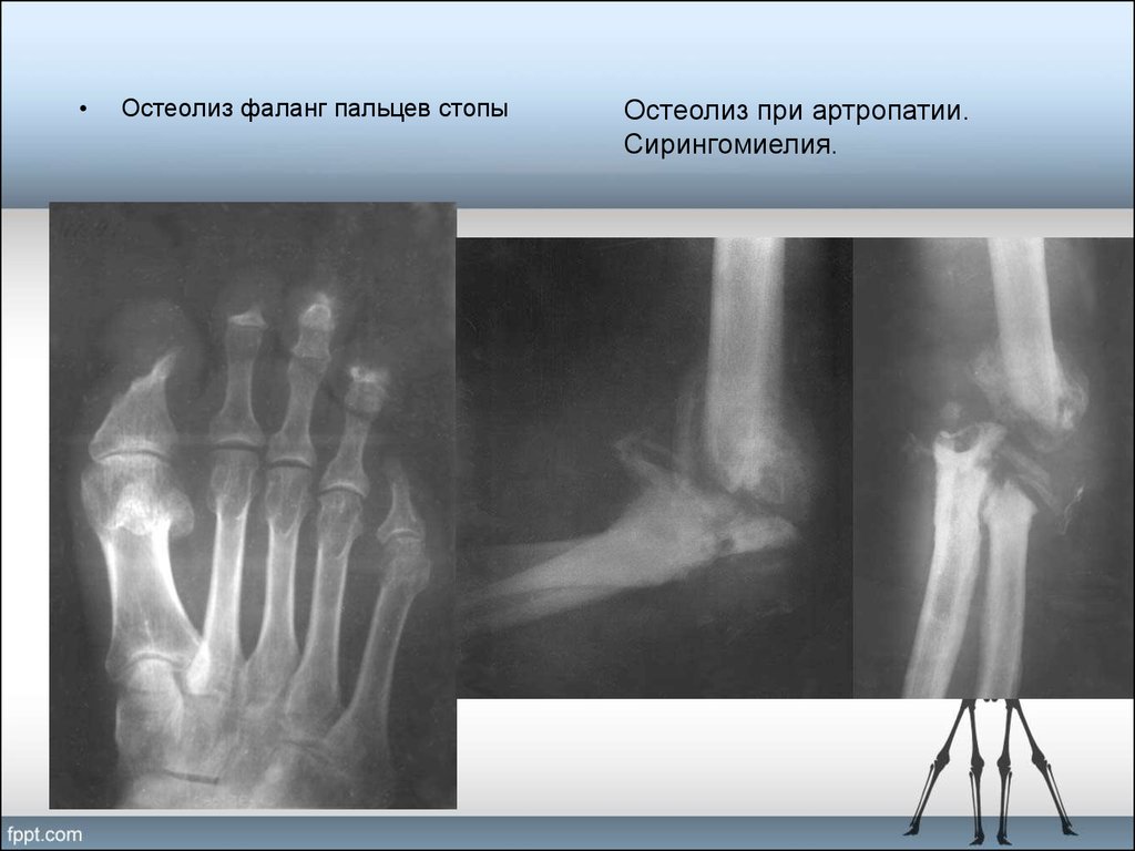 Остеолиз это. Остеолизис бедренной кости. Остеолиз фаланг пальцев. Остеолиз костей рентген.