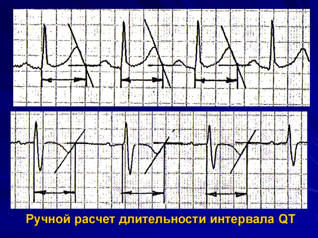 Интервал qt на экг норма