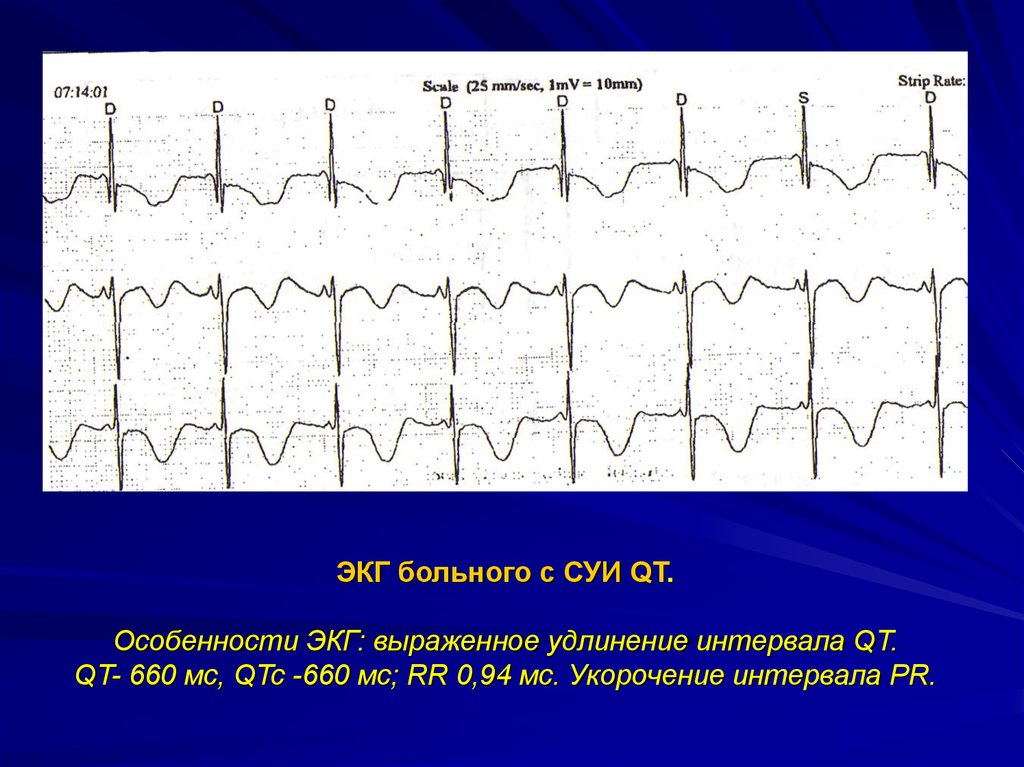 Удлинение интервала qt. Синдром удлиненного qt на ЭКГ. Синдром укороченного qt на ЭКГ. Синдром удлинения интервала qt ЭКГ. Удлинённый интервал qt на ЭКГ.