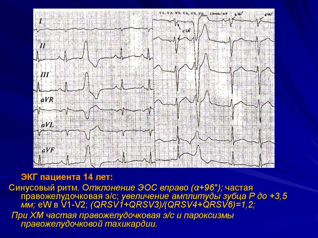 Отклонения на экг. ЭКГ ритм синусовый отклонение ЭОС. Синусовый ритм отклонение вправо. Отклонение вправо ЭОС на кардиограмме. Отклонение электрической оси вправо на ЭКГ.