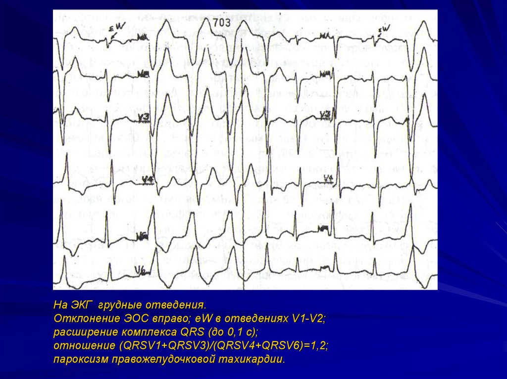 Отклонения на экг. Отклонение оси на ЭКГ. Отклонение ЭОС на ЭКГ. Отклонение оси вправо на ЭКГ. Расширение комплекса QRS на ЭКГ.