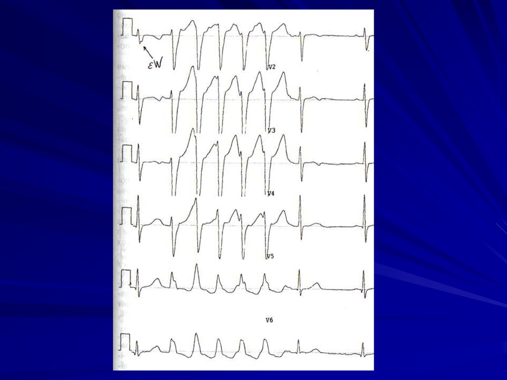 Экг синдромы. Правожелудочковая пароксизмальная тахикардия. Редкие ЭКГ синдромы. Кардиоцеребральный синдром на ЭКГ. Цереброкардиальный синдром на ЭКГ.