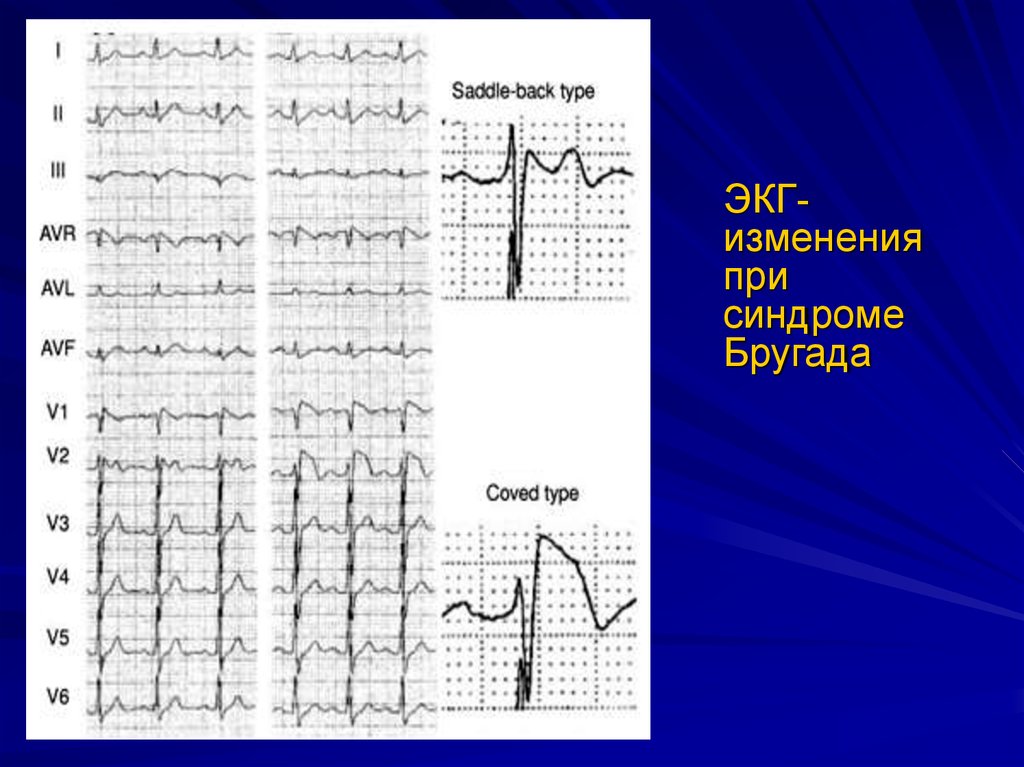 Изменения на экг. Синдром Wellens на ЭКГ. 1. ЭКГ изменения при синдроме Бругада.. V1 v3 при синдроме Бругада ЭКГ. Подъем St в AVR на ЭКГ.