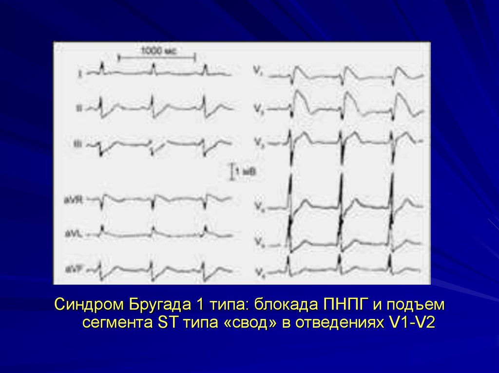 Подъем st v2. Синдром Бругада на ЭКГ 1 типа. ЭКГ подъем St в v1 v2 v3. Подъем сегмента St на ЭКГ v1 v2 v3. Подъем сегмента St на ЭКГ v3.