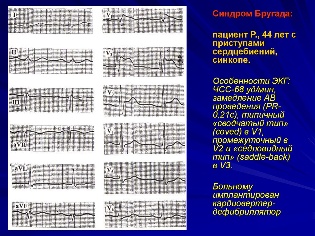 Синдром бругада на экг фото