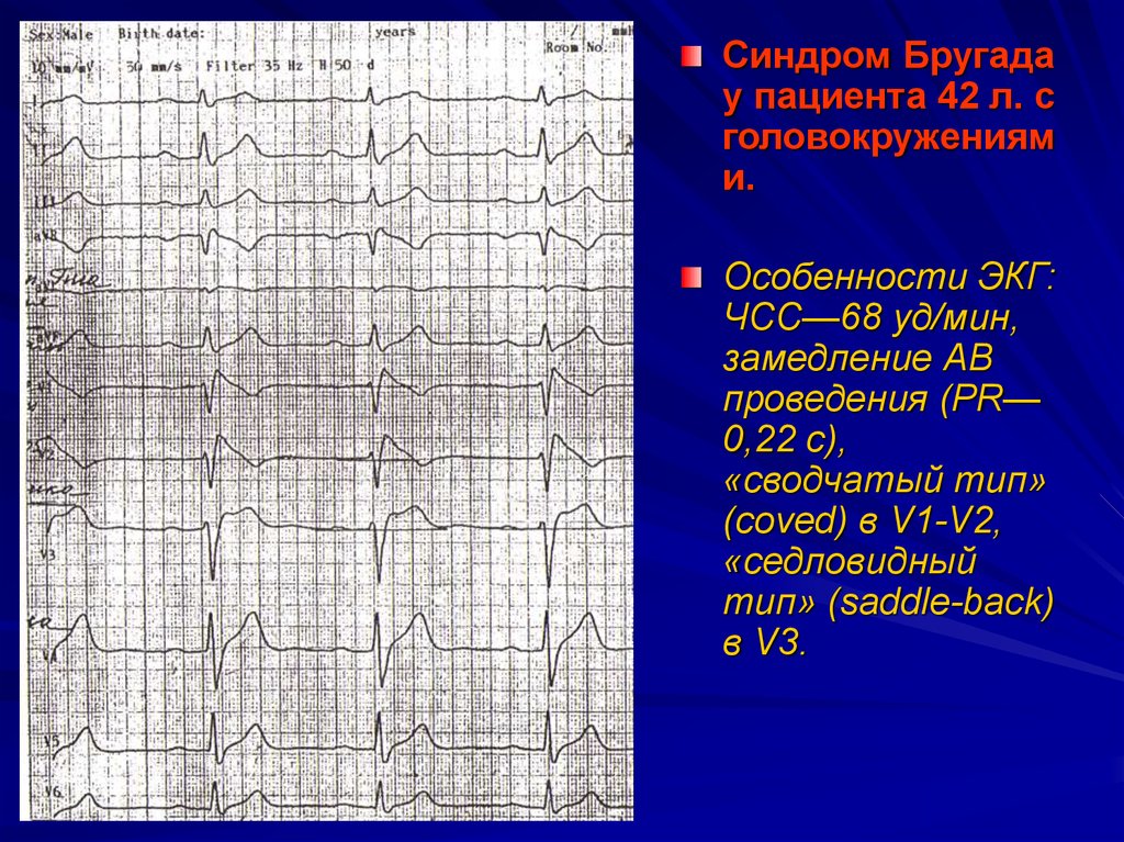 Экг синдромы. Синдром Бругада Тип 2 ЭКГ. Синдром Бругада 1 Тип. Синдром Бругада на ЭКГ. Синдром Бругада на ЭКГ Тип 3.