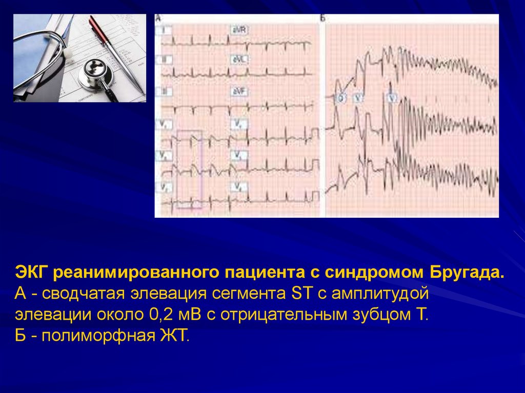 Экг синдромы. Синдром Бругада ЭКГ признаки. ЭКГ-критерии синдрома Бругада 3 типа. ЭКГ больного с синдромом Бругада. Отрицательный зубец т на ЭКГ 2, 3 AVF.