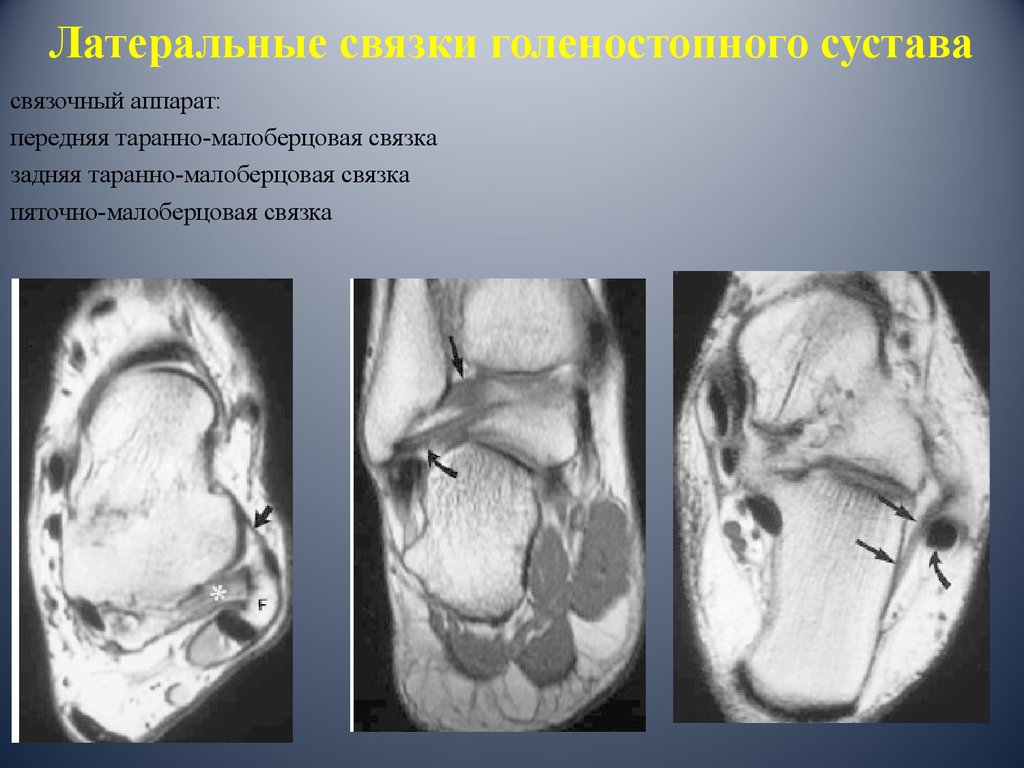 Задняя таранно малоберцовая связка. Таранно-пяточная связка мрт. Мрт разрыв пяточно малоберцовой связки. Таранно-малоберцовая связка голеностопного сустава мрт. Разрыв таранно малоберцовой связки мрт.