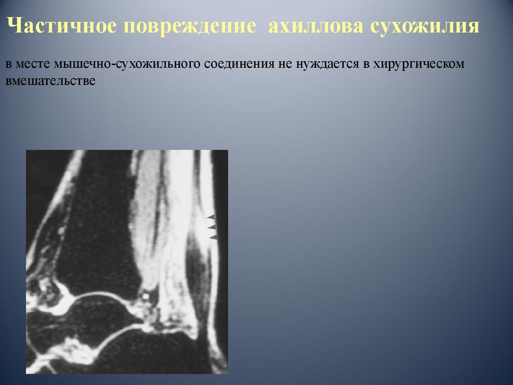 Частичный разрыв сухожилия. Разрыв ахиллова сухожилия на УЗИ протокол. Разрыв ахиллового сухожилия УЗИ. Разрыв ахиллова сухожилия на УЗИ. Повреждение ахиллова сухожилия мрт.