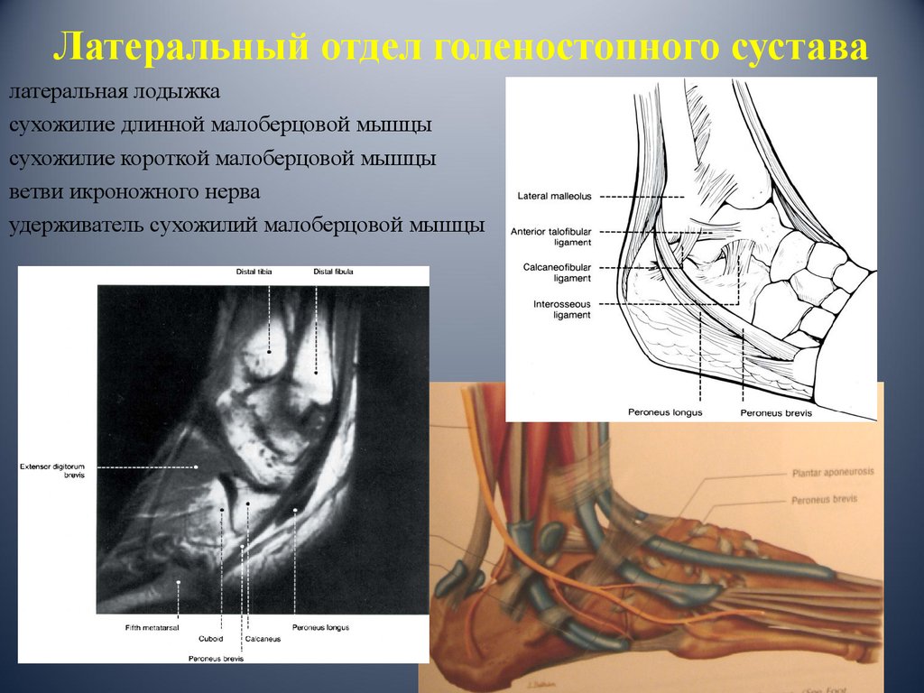Мышцы щиколотки. Латеральная лодыжка анатомия. Сумки голеностопного сустава анатомия мрт. Латеральная лодыжка мрт. Медиальная лодыжка анатомия.