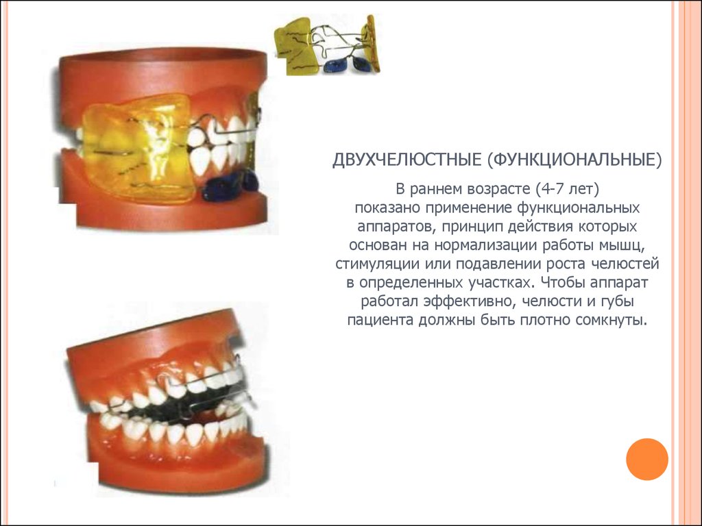 Функционировать аппарат. Двухчелюстные ортодонтические аппараты. Одночелюстной аппарат в ортодонтии. Двухчелюстной съемный ортодонтический аппарат. Двухчелюстные аппараты в ортодонтии.