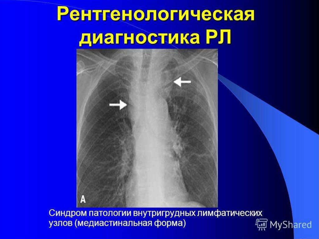 Презентация на тему рак легкого