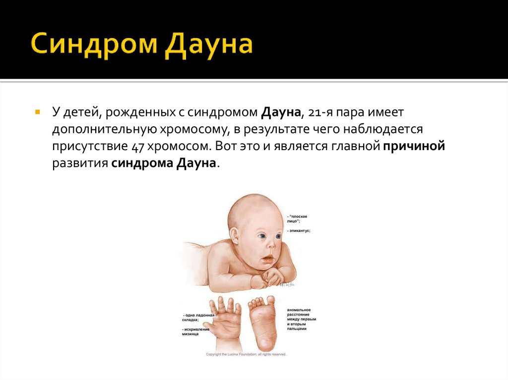 Какие есть синдромы дауна. Синдром Дауна. Синдром Дауна у новорожденных. Симптомы синдрома Дауна у новорожденных. Новорожденный ребенок с синдромом Дауна.